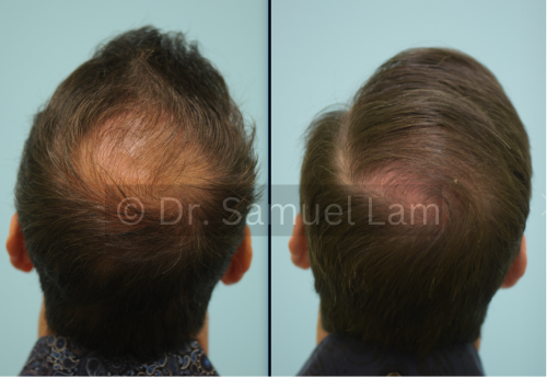 topical finasteride results in a male patient