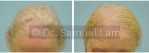 topical minoxidil results in a female patient