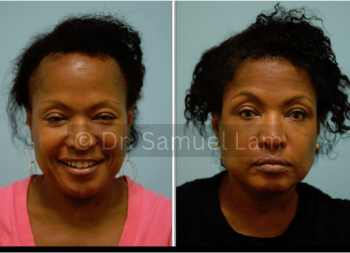 traction alopecia in a black woman