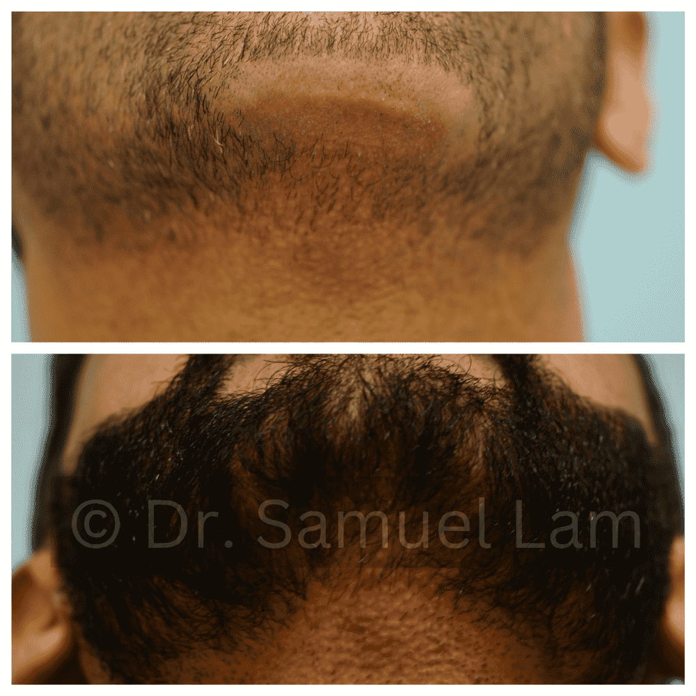 before and after chin scar correction