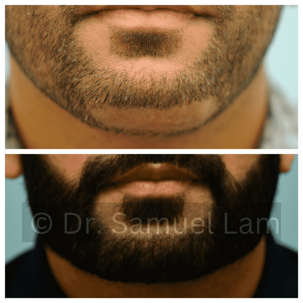 chin scar correction using beard transplant