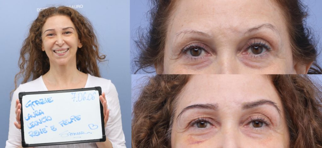 eyebrow hair transplant