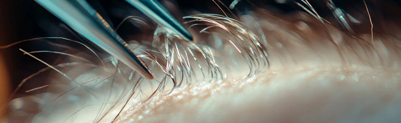 management complications hair transplant