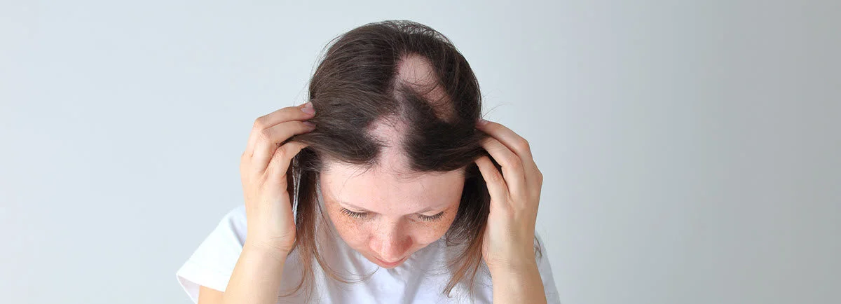 A woman with alopecia areata shows patches of no hair on the scalp.