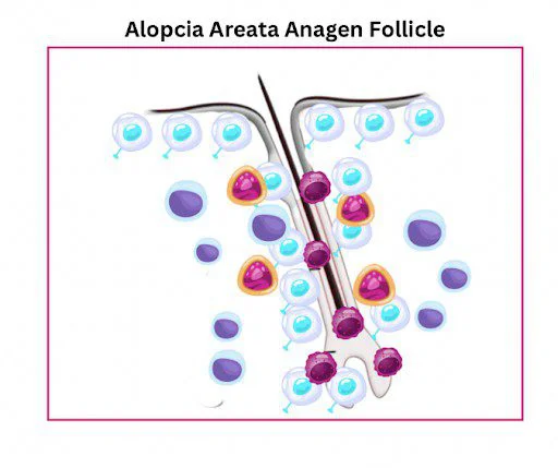 alopecia areata anagen follicle