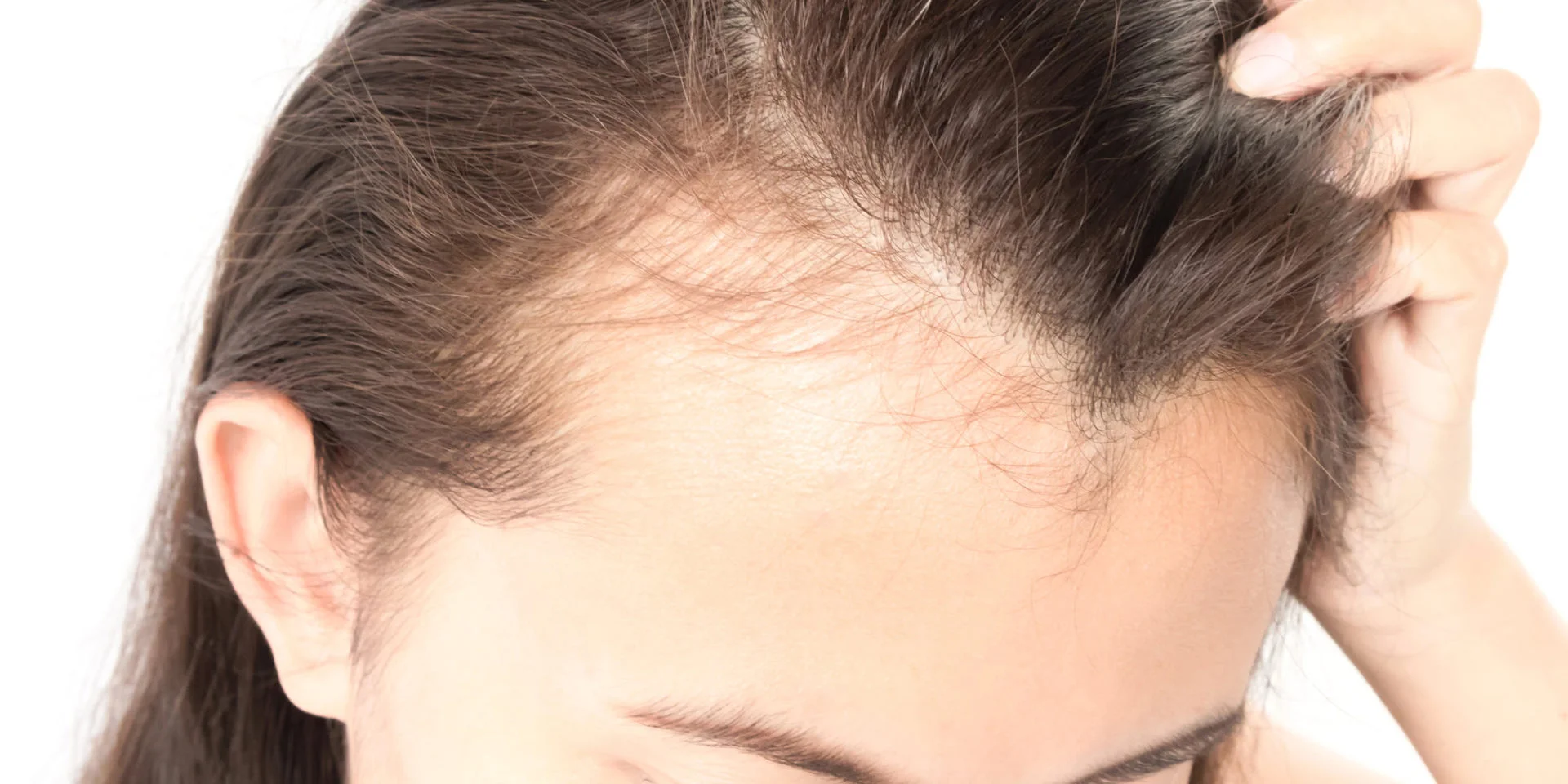 female hair loss