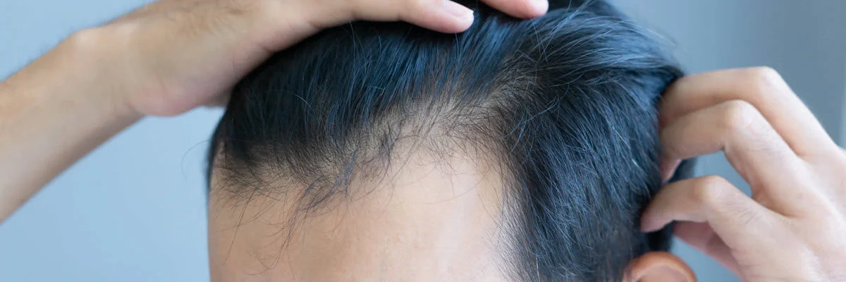hair loss treatments