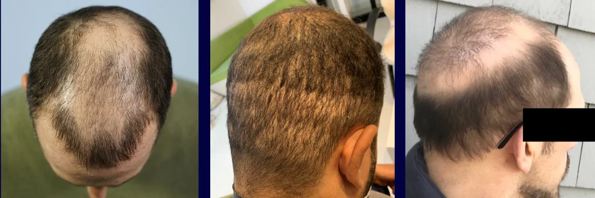 hair transplant correction black market