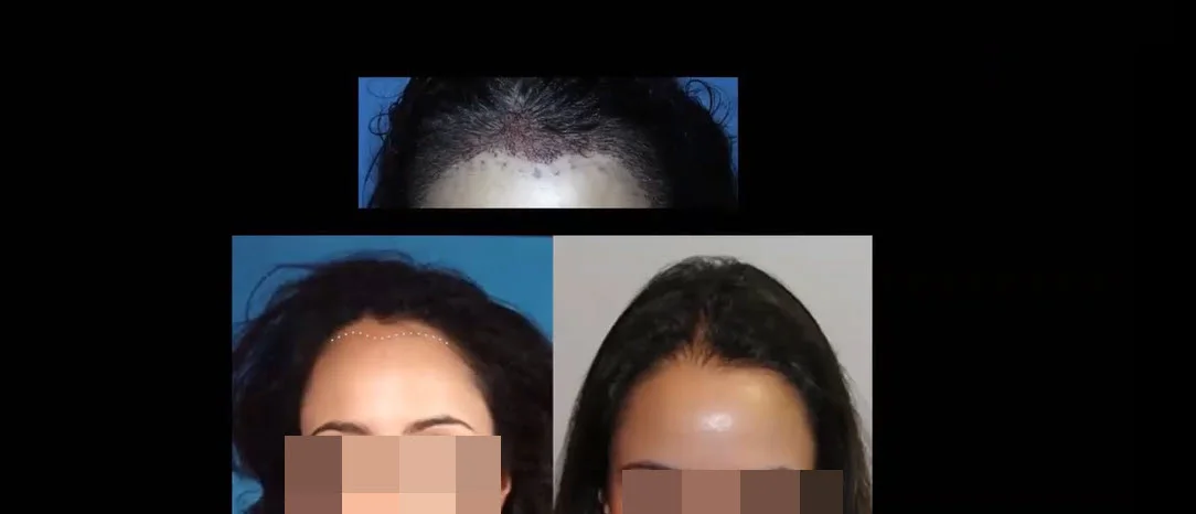 female-hair restoration