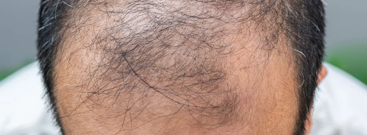 root cause hair loss in men